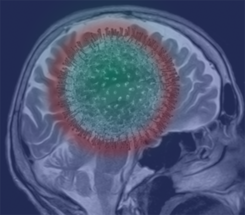 A blue washed Brain MRI with a red blob to signify stroke in the back region of the brain