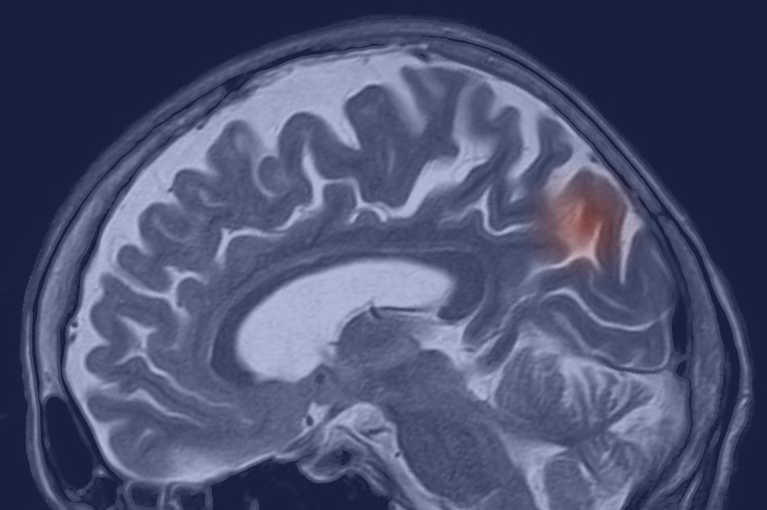 A blue washed Brain MRI with a red blob to signify stroke in the back region of the brain